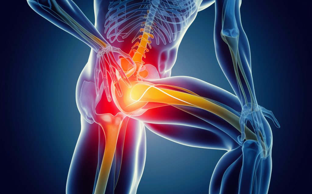An anatomical illustration highlighting the sciatic nerve and regions of back and leg pain associated with sciatica, with the affected areas shown in shades of red and orange.